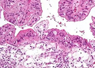 【Science速递】“沉默的杀手”卵巢癌的治疗新靶点终于被发现了